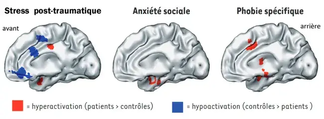 Impacts sur le cerveau