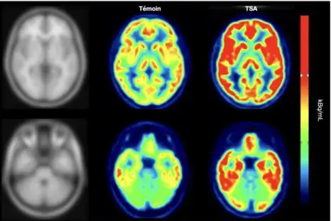 Le cerveau autiste